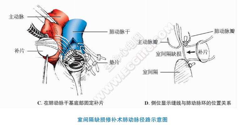 室间隔缺损修补术肺动脉径路示意图（C．在肺动脉干基底部固定补片。D.侧位显示缝线与肺动脉环的位置关系）