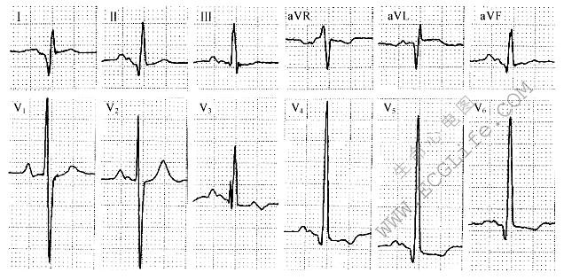 二尖瓣型P波心电图