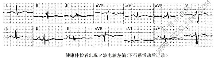 P波电轴左偏（心电图）
