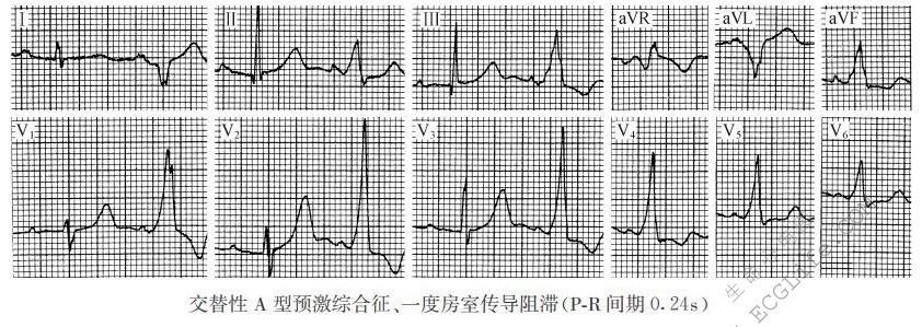 交替性A型预激综合征、一度房室传导阻滞（心电图）