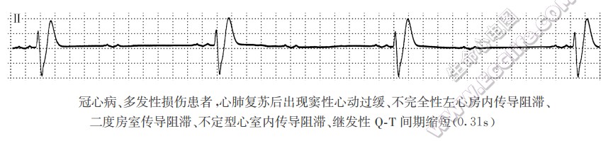 冠心病、多发性损伤患者，心肺复苏后出现窦性心动过缓、不完全性左心房内传导阻滞、二度房室传导阻滞、不定型心室内传导阻滞、继发性QT间期缩短(0.31s)（心电图）