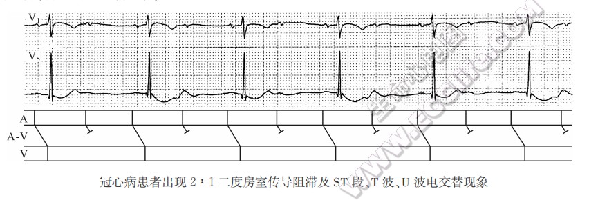 冠心病患者m现2：1二度房室传导阻滞及ST段、T波、U波电交替现象（心电图）