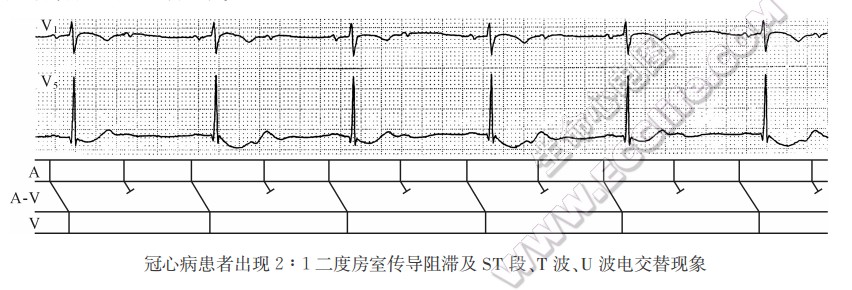 U波电交替现象