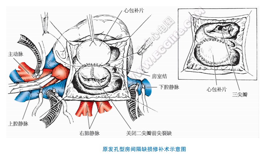 发孔型房间隔缺损修补术手术示意图