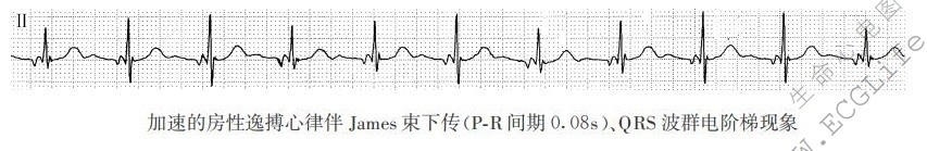 QRS波群电阶梯现象（心电图）