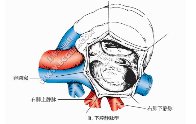 下腔静脉型继发孔型房间隔缺损