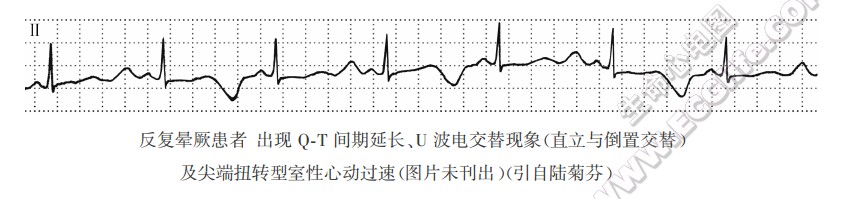 U波电交替现象（心电图）