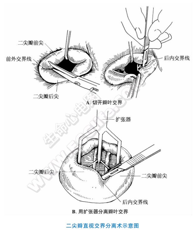 风湿性二尖瓣病变（二尖瓣狭窄、关闭不全）与手术治疗