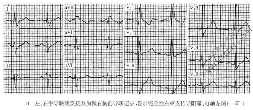 完全性右束支传导阻滞、电轴左偏