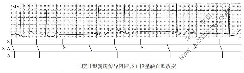 二度Ⅱ型窦房传导阻滞、ST段呈缺血型改变（心电图）
