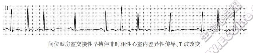 间位型房室交接性早搏伴非时相性心室内差异性传导、T波改变（心电图）