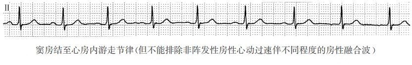 窦房结至心房内游走节律（心电图）