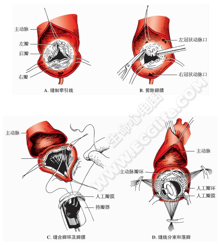 主动脉瓣置换术示意图1
