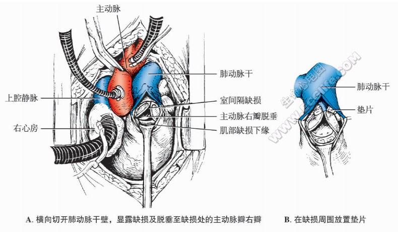 室间隔缺损修补术肺动脉径路示意图（A.横向切开肺动脉千壁，显露缺损及脱垂至缺损处的主动脉辫右辫。B.在缺损周围放置垫片）
