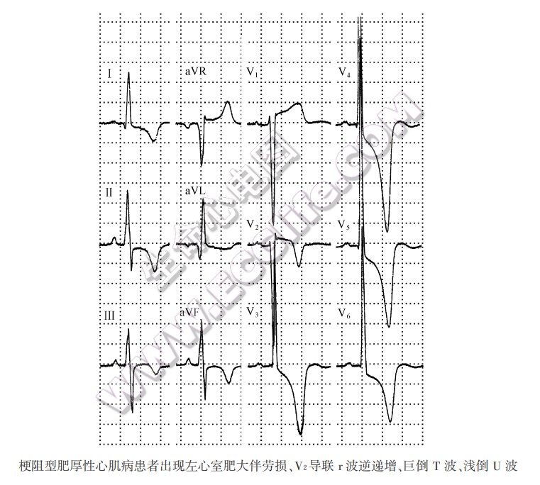 劳损型T波倒置（心电图）