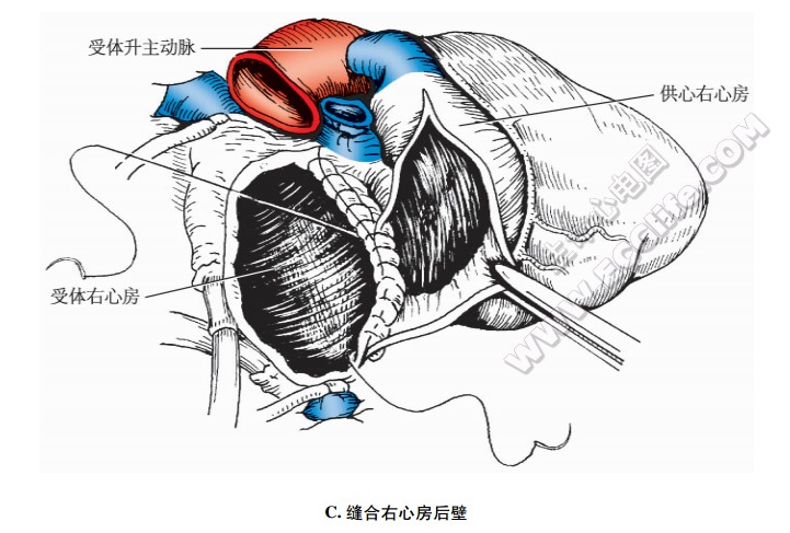 原位心脏移植：缝合右心房后壁