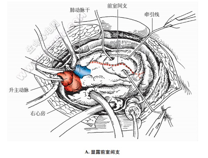 冠心病治疗手术：升主动脉冠状动脉旁路术、前室间支