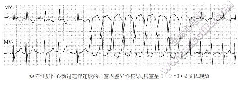 短阵性房性心动过速伴连续的心室内差异性传导、房室呈文氏现象（心电图）