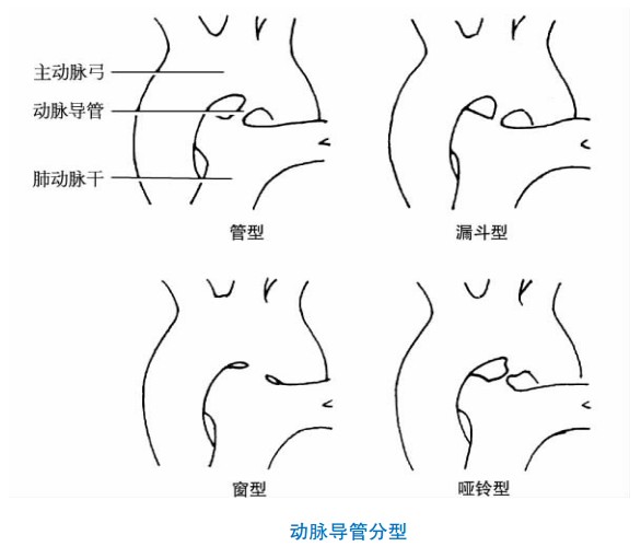 先天性动脉导管未闭与手术关闭治疗操作