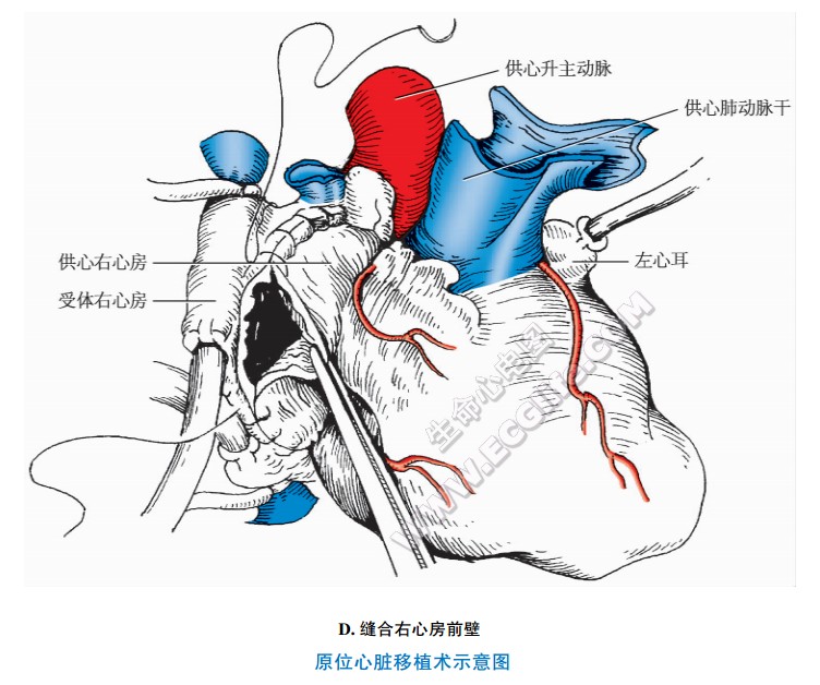 原位心脏移植：缝合有心脏前壁