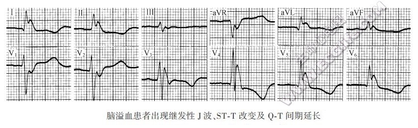 脑溢血患者出现继发性J波（心电图）