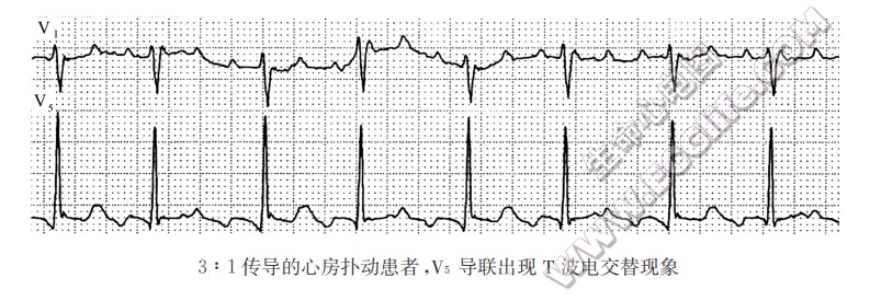 3:1传导的心房扑动患者，Vs导联出现T波电交替现象（心电图）