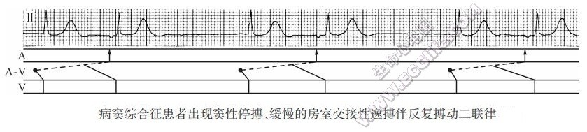 病窦综合征患者出现窦性停搏、缓慢的房室交接性逸搏伴反复搏动二联律（心电图）