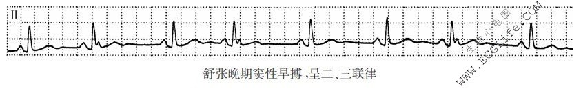 舒张晚期窦性早搏（心电图）