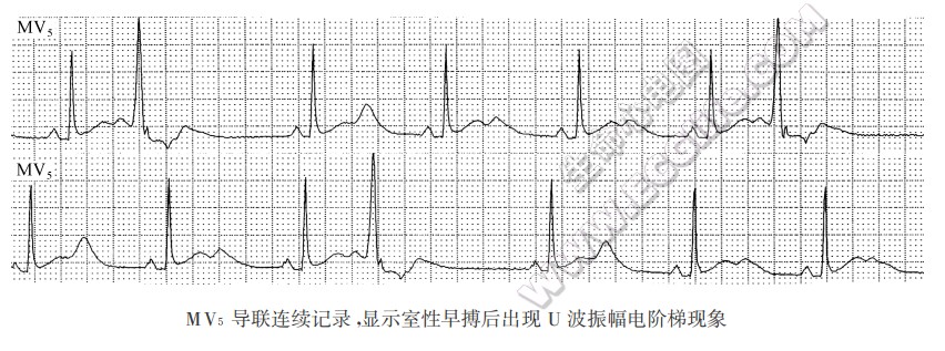 MV5导联连续记录，显示室性早搏后出现U波振幅电阶梯现象（心电图）