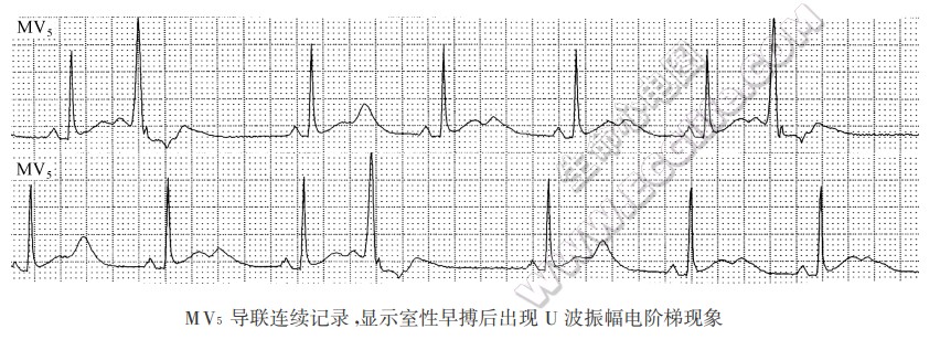 双相型U波改变、早搏后U波改变