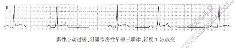 窦性心动过缓、阻滞型房性早搏三联律、轻度T波改变（心电图）