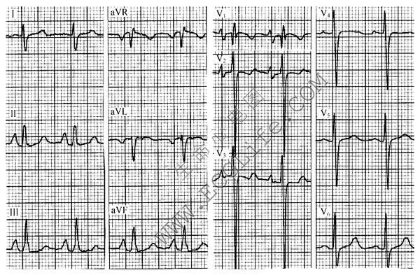 年轻人心电图p波高尖图片