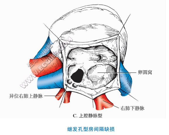 上腔静脉型继发孔型房间隔缺损