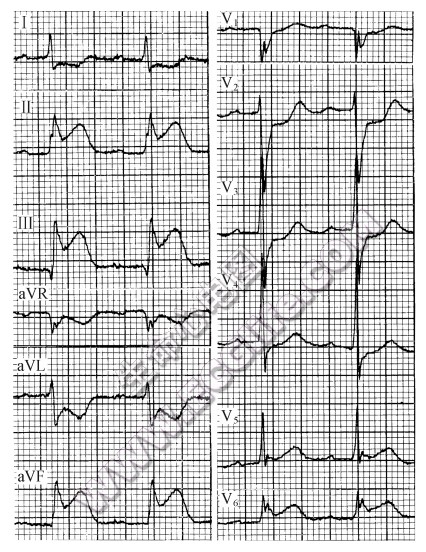ST段呈上斜型（斜直型）抬高（心电图）