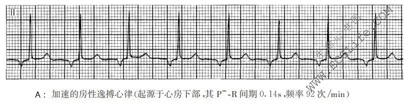 加速的房性逸搏心律（心电图）