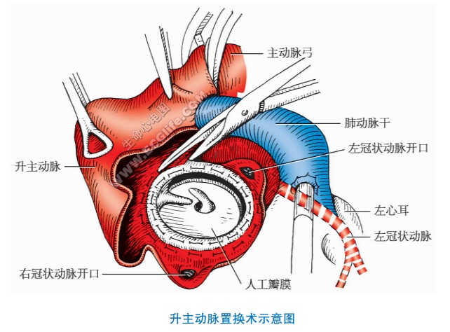 各主动脉瘤与手术治疗