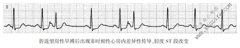 折返型房性早搏后出现非时相性心房内差异性传导、轻度ST段改变（心电图）