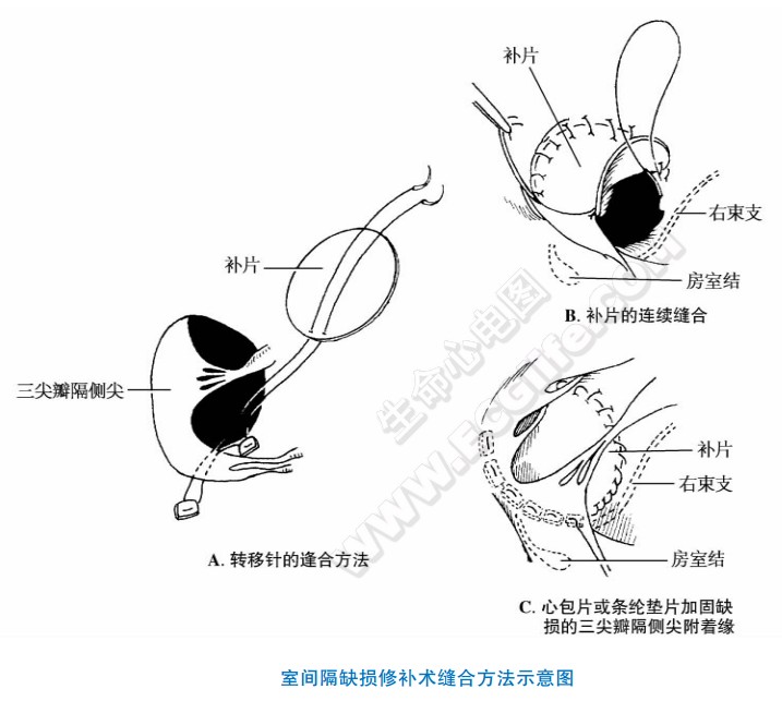 室间隔缺损修补术手术缝合方法示意图