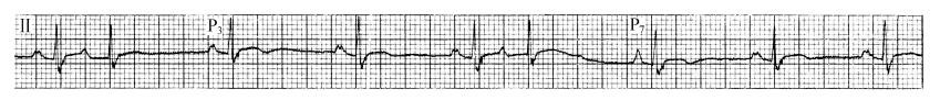 房性逸搏（心电图）