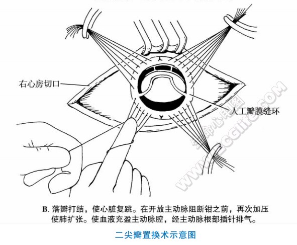 二尖瓣置换术示意图（落瓣打结，使心脏复跳。在开放主动脉阻断钳之前．再次加压使肺扩张。使血液充盈主动脉腔，经主动脉根部插针排气。）