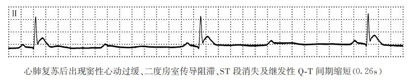 ST段缩短（心电图）