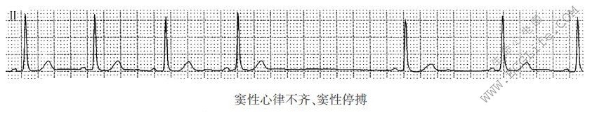 窦性心律不齐、窦性停搏（心电图）