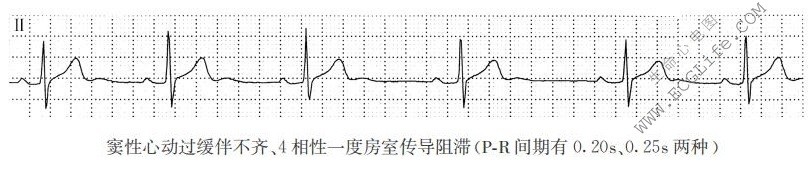 4相性一度房室传导阻滞