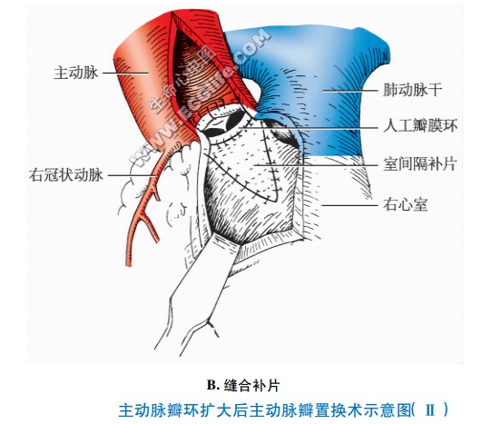 主动脉瓣环扩大后主动脉瓣置换术示意图（缝合补片）