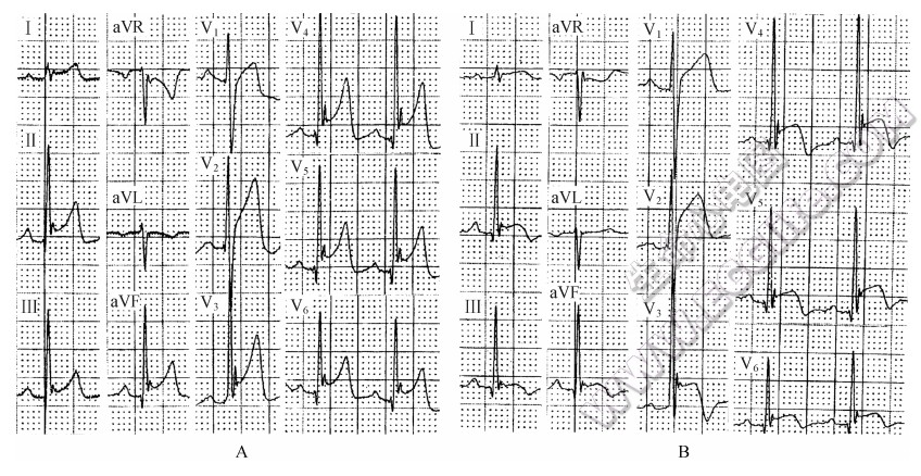 ST段呈凹面向上型抬高（心电图）