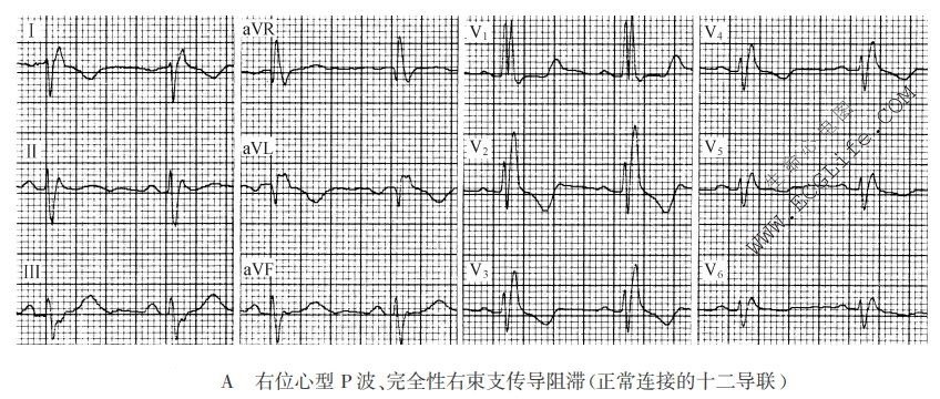 右位心型P波、完全性右柬支传导阻滞（正常连接的十二导联）