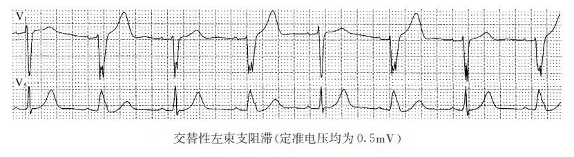 交替性左柬支阻滞（心电图）