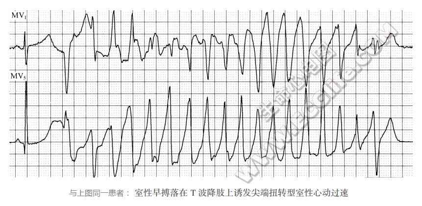 室性早搏落在T波降肢上诱发尖端扭转型室性心动过速（心电图）