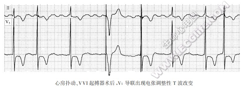 心房扑动、VVI起搏器术后，V5导联出现电张调整性T波改变（心电图）