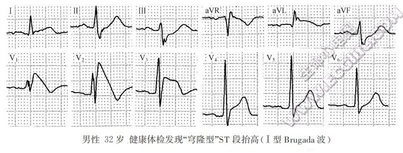 穹隆型ST段抬高（心电图）